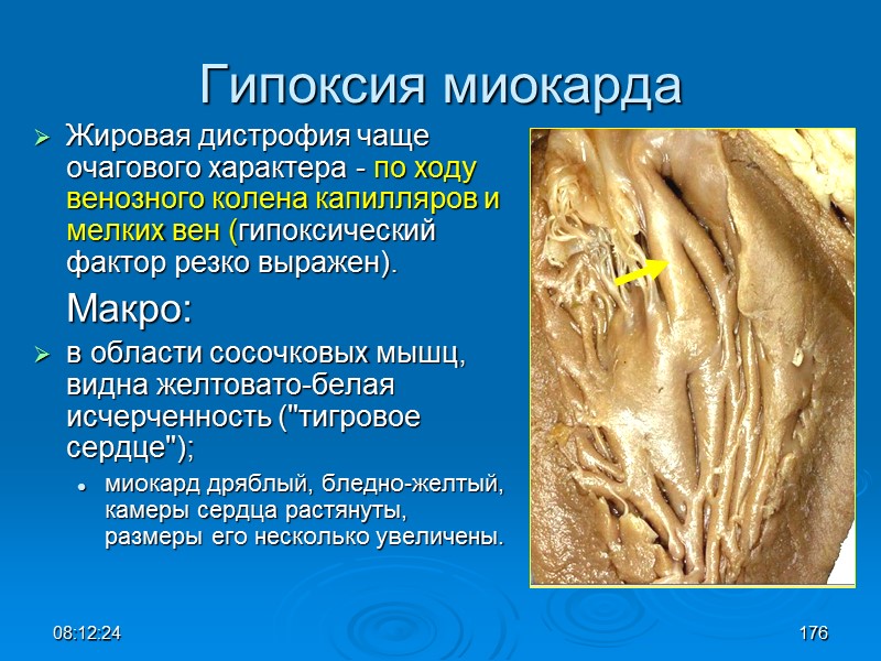 08:12:02 Гипоксия миокарда Жировая дистрофия чаще очагового характера - по ходу венозного колена капилляров